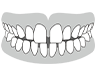 すきっ歯（空隙歯列）