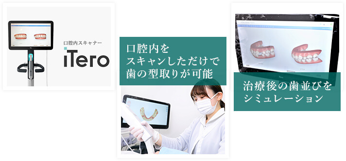 口腔内スキャナー『iTero element』で精密な歯型取りを快適に